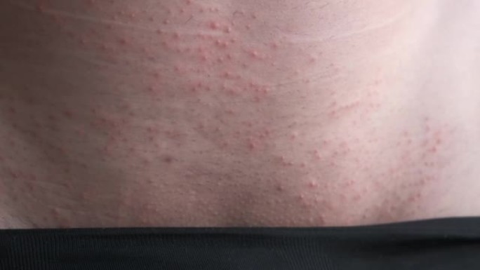 皮疹在一个男人的皮肤在腹股沟区，性病的概念。