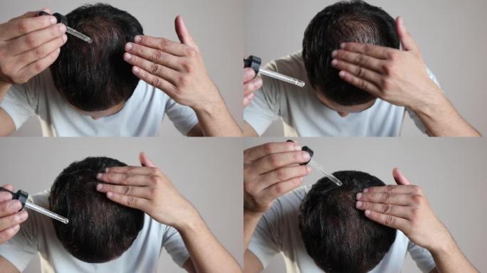 男性使用米诺地尔油治疗秃发