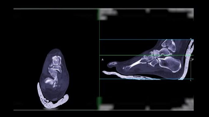 足部冠状面和矢状面ct扫描诊断骨折。