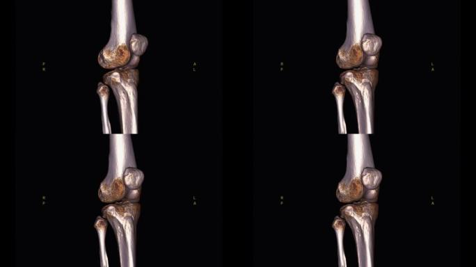 膝关节三维渲染的ct扫描。