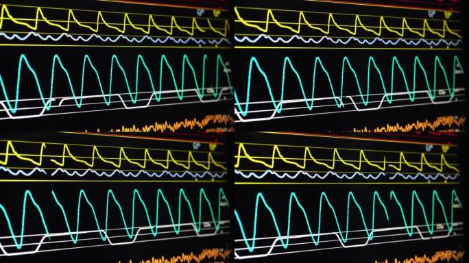 生命体征监测波形心电图特写视频素材