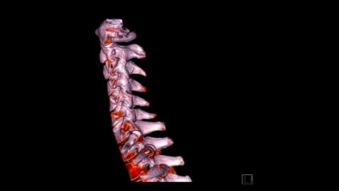 颈椎ct扫描。