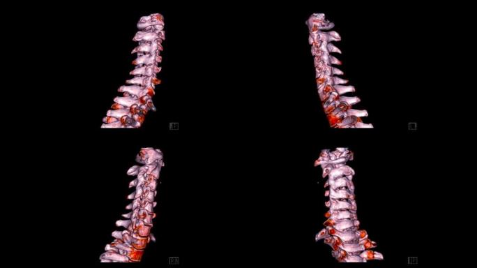 颈椎ct扫描。