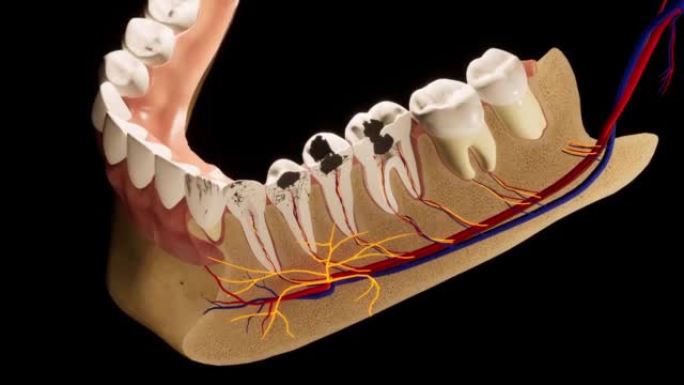 龋齿损坏的臼齿。医学上精确的牙齿3D动画
