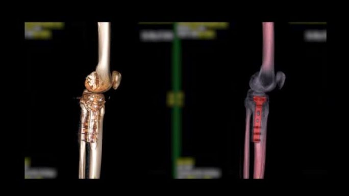 膝关节三维渲染的ct扫描。