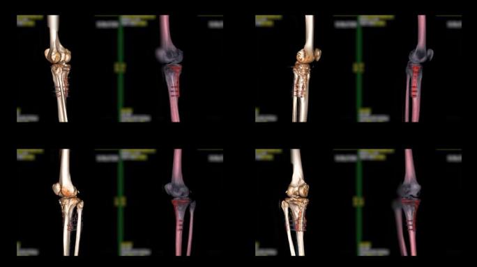 膝关节三维渲染的ct扫描。