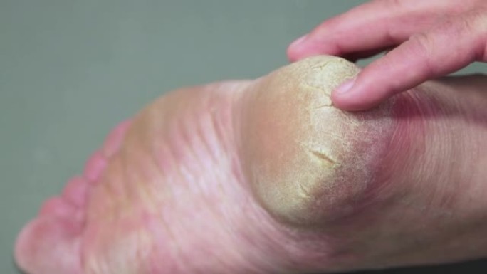 一个男人的手抚摸着脚后跟角质化的皮肤。