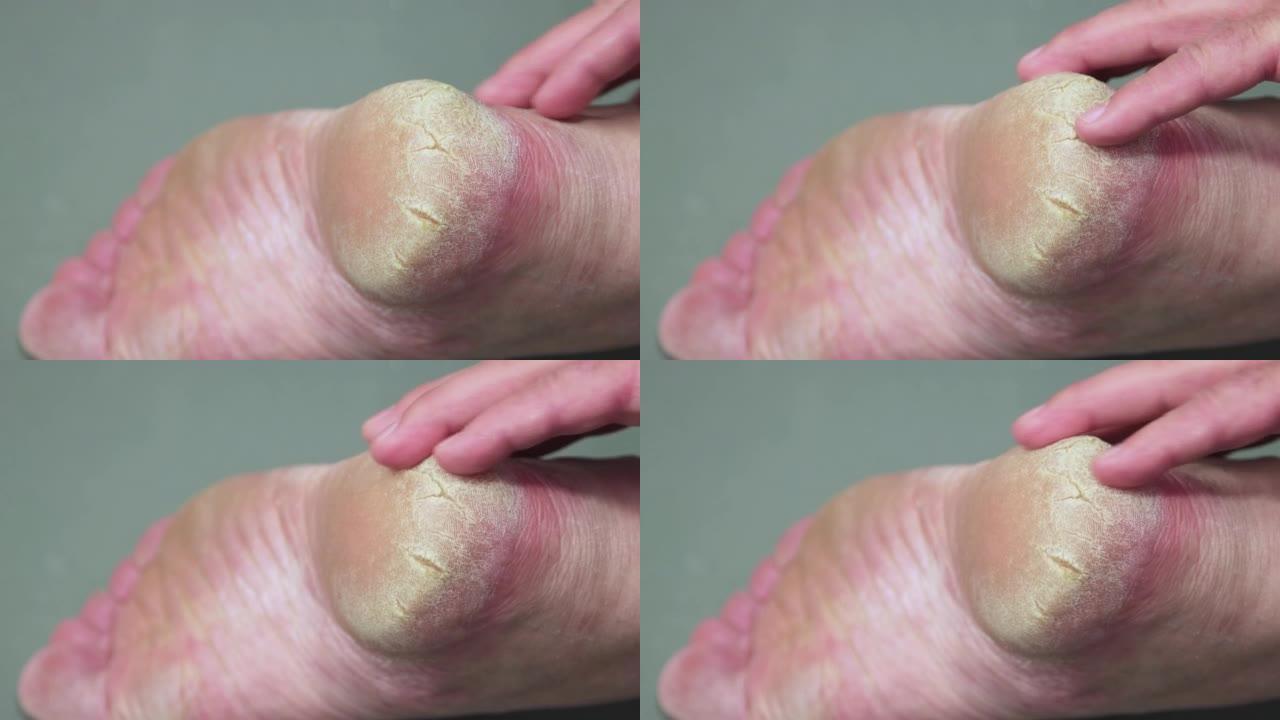 一个男人的手抚摸着脚后跟角质化的皮肤。