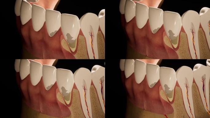 龋齿损坏的臼齿。医学上精确的牙齿3D动画