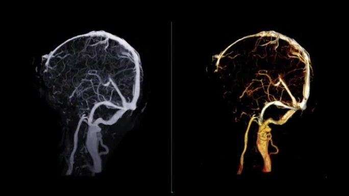 CTV脑部扫描3D渲染诊断静脉窦血栓形成。