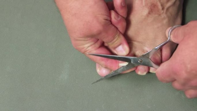 一只手用金属剪刀剪断了一名男子脚趾的指甲。