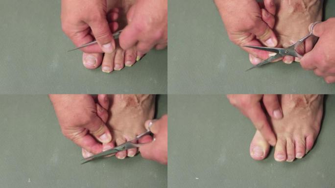 一只手用金属剪刀剪断了一名男子脚趾的指甲。