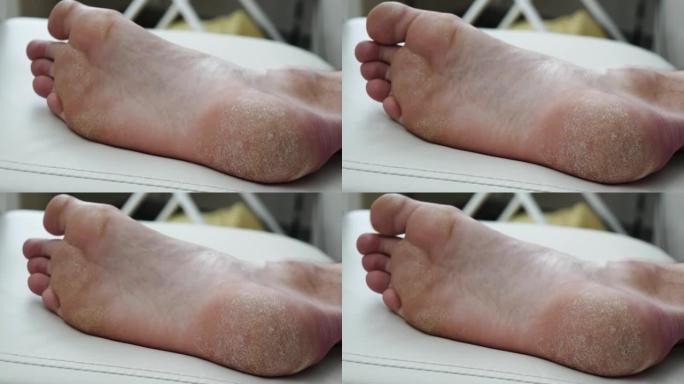 人的脚。皮肤干燥，脚的牛皮癣。皮肤受损。皮炎，湿疹，银屑病，过敏反应。特写-人的脚脱皮和开裂。真菌感