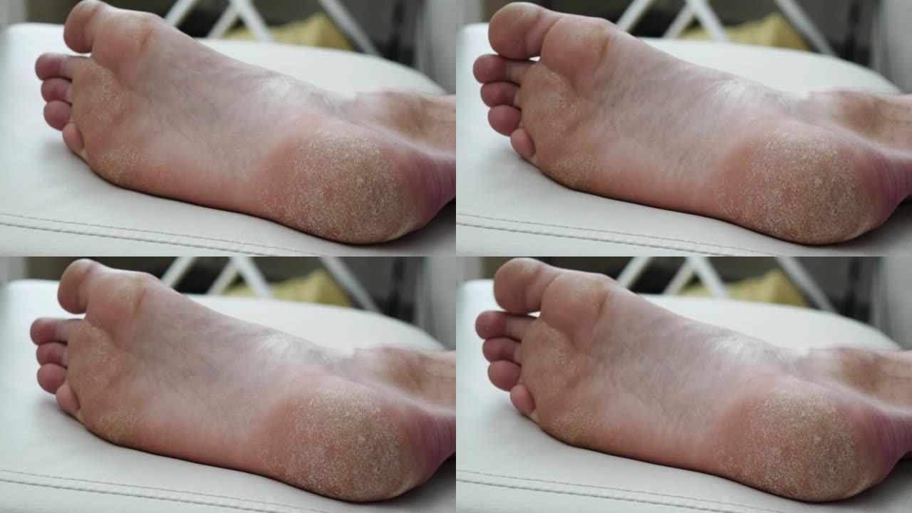 人的脚。皮肤干燥，脚的牛皮癣。皮肤受损。皮炎，湿疹，银屑病，过敏反应。特写-人的脚脱皮和开裂。真菌感
