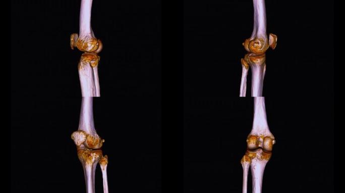 膝关节三维渲染的ct扫描。