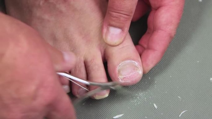 金属钳将钉子夹在男人脚的大脚趾上。
