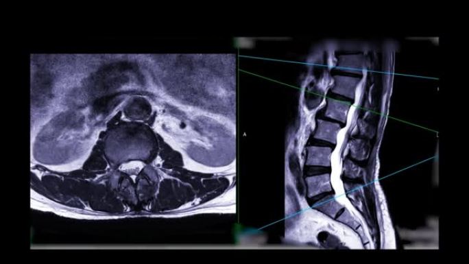 MRI l-s脊柱或腰椎轴向T2W视矢状面诊断脊髓压迫。
