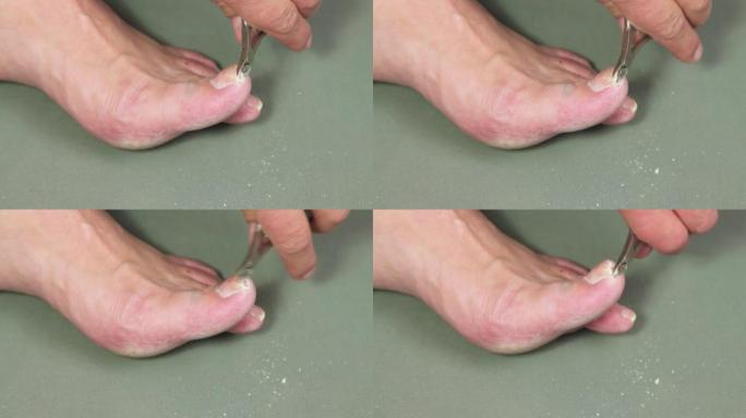 一只拿着钢丝钳的手正在切割一名男子脚掌的食指指甲。