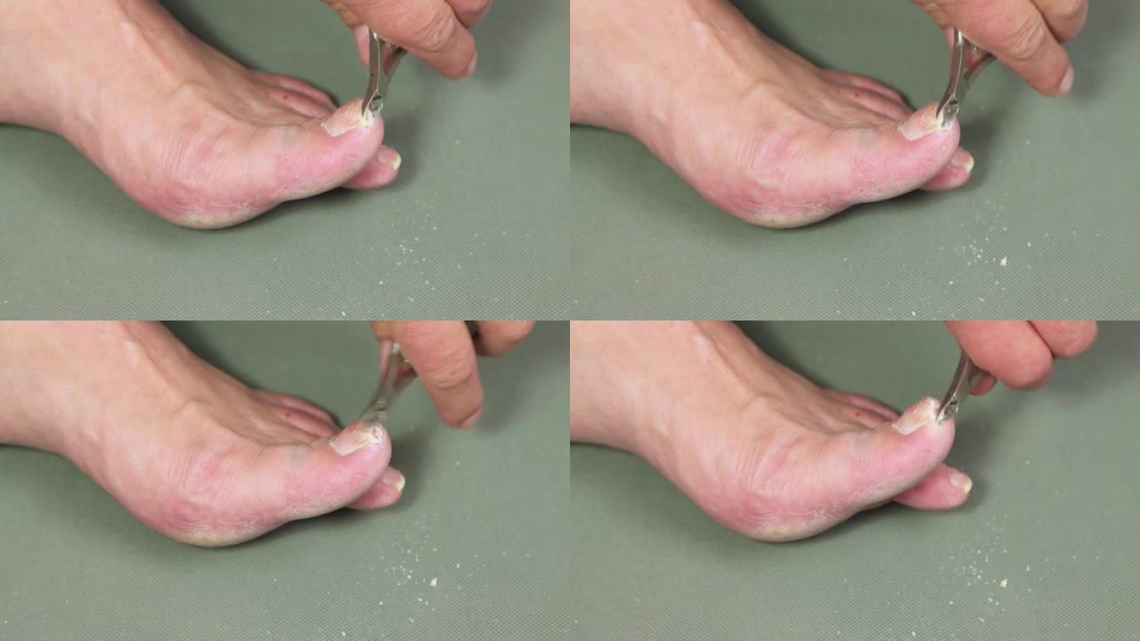 一只拿着钢丝钳的手正在切割一名男子脚掌的食指指甲。
