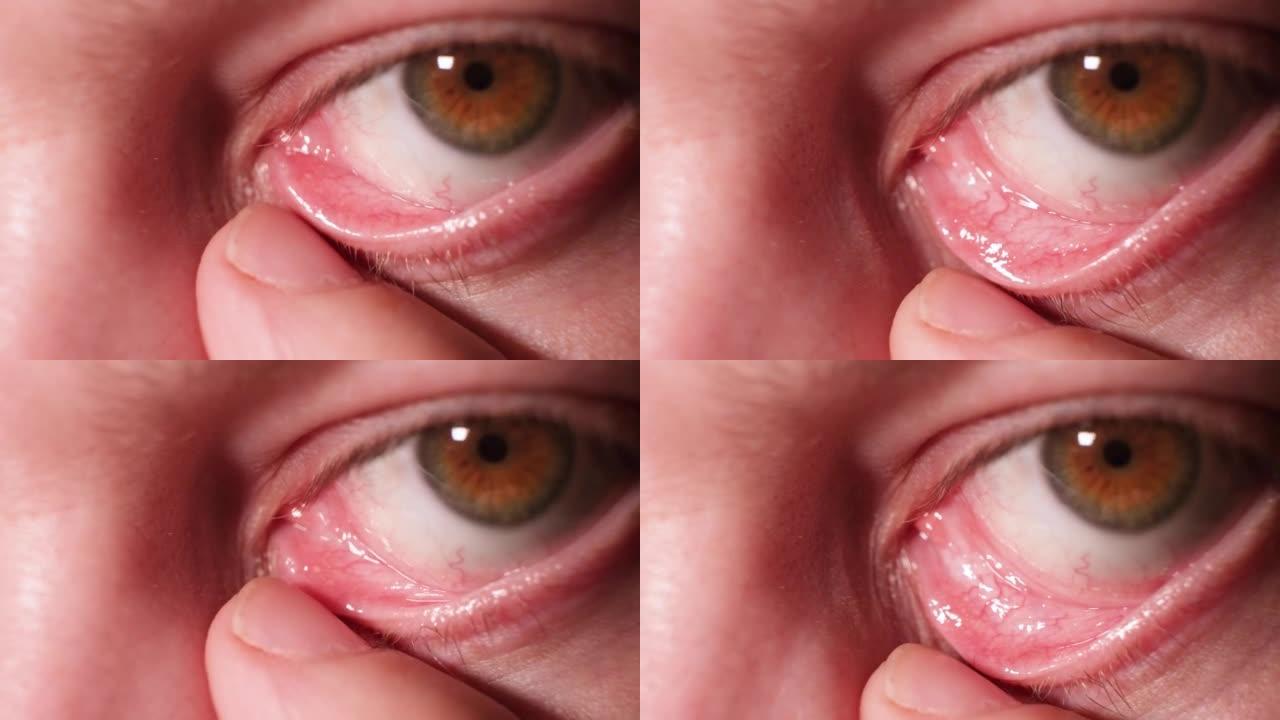男人的眼睛，结膜粘膜的宏观视频。结膜炎，眼疾。