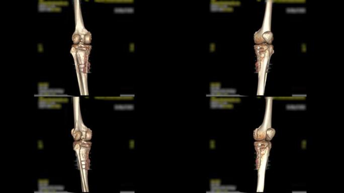 膝关节三维渲染的ct扫描。