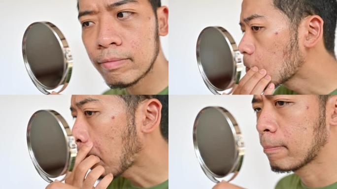 忧心忡忡的亚洲男子用迷你镜子看到脸上出现丘疹或痤疮的问题。