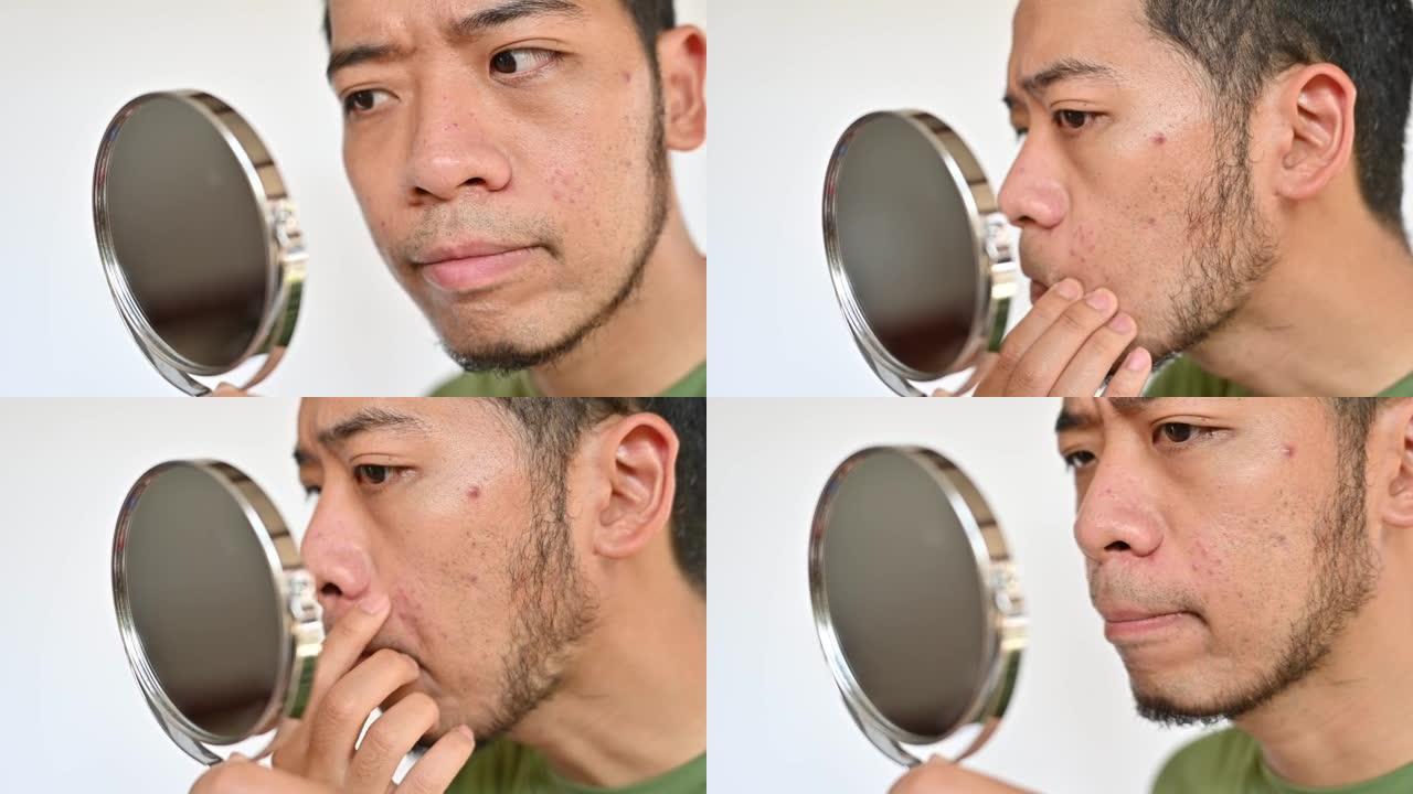 忧心忡忡的亚洲男子用迷你镜子看到脸上出现丘疹或痤疮的问题。