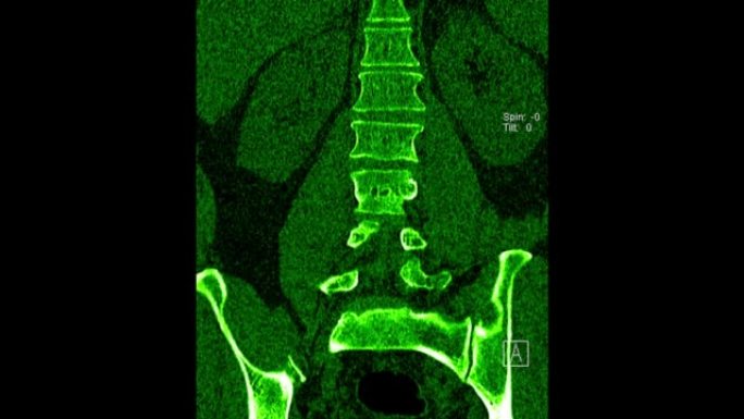 腰椎CT