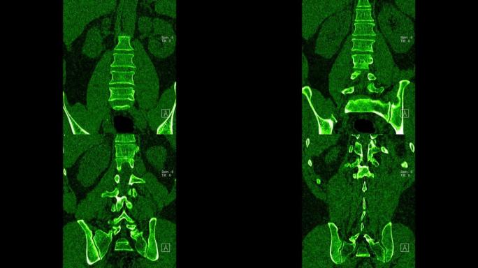 腰椎CT