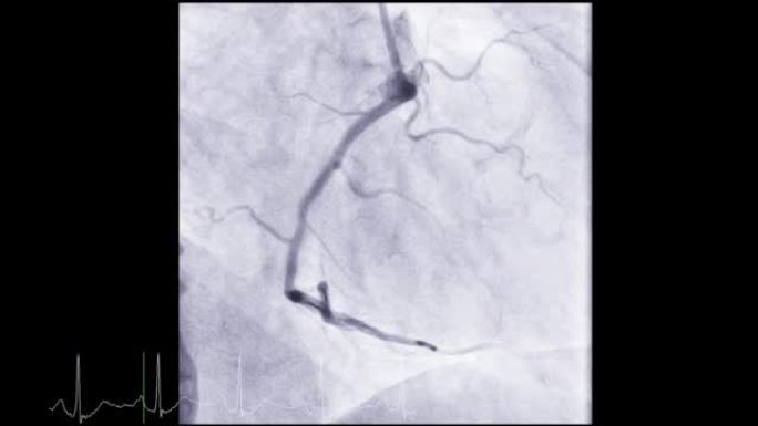 显示冠状动脉的心导管检查以诊断心脏骤停。