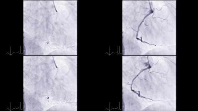 显示冠状动脉的心导管检查以诊断心脏骤停。