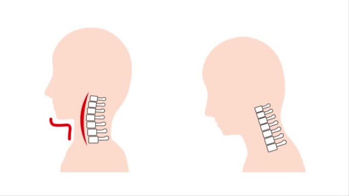 这是一个动画视频，显示了直颈 (智能颈) 和正常颈骨以及脖子周围下垂的图像。