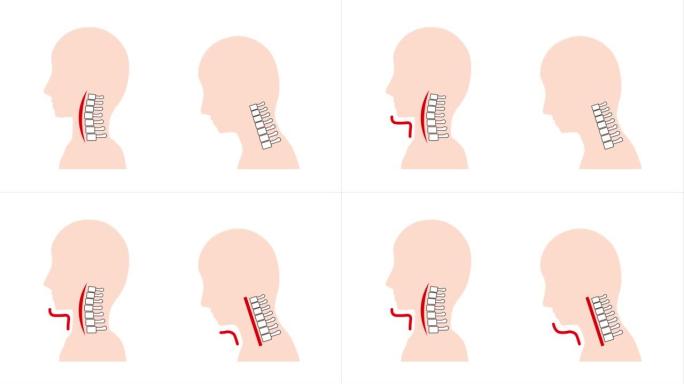这是一个动画视频，显示了直颈 (智能颈) 和正常颈骨以及脖子周围下垂的图像。