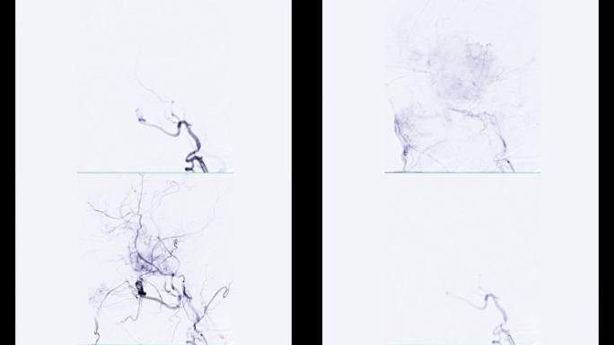 脑血管造影术。