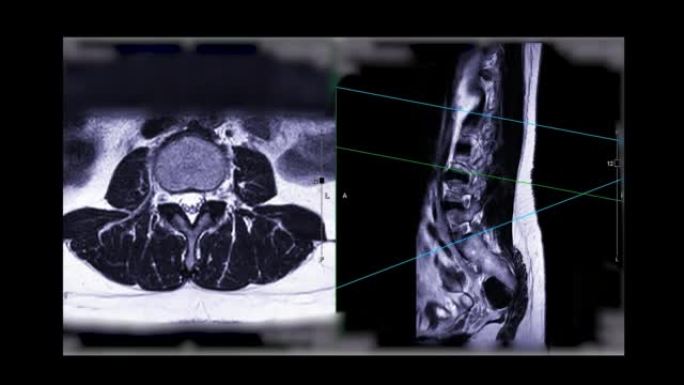 MRI l-s脊柱或腰椎。