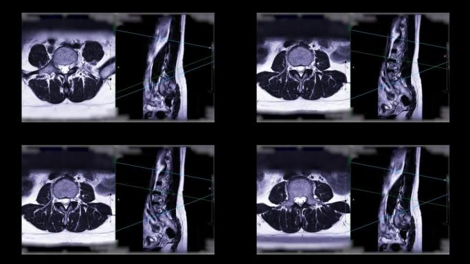 MRI l-s脊柱或腰椎。