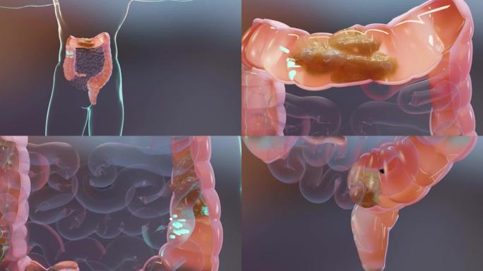 人体消化系统解剖，肠道概念，泻药，便秘治疗，3d渲染