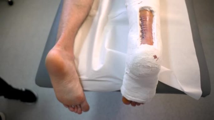 石膏中腿部手术缝线的B卷