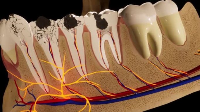 龋齿损坏的臼齿。医学上精确的牙齿3D动画