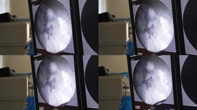 显示手术器官超声图像的屏幕。特写。现代化手术室的设备。
