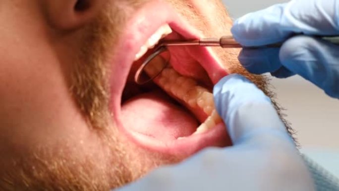 患者张口坐在牙医的椅子上，医生检查口腔，特写。