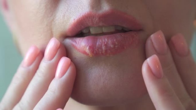 受疱疹疾病影响的女性嘴唇。特写。