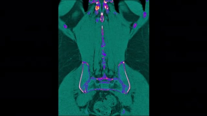 腰椎ct扫描颜色。