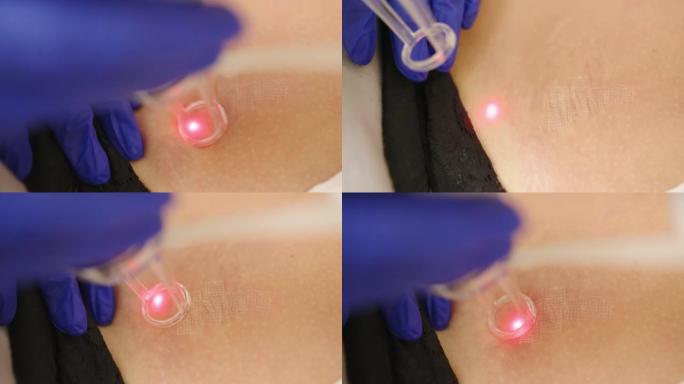 皮肤科的激光整容手术和皮肤重铺。在护肤诊所使用激光，用于皮肤皱纹，疤痕和日光损伤的重铺技术