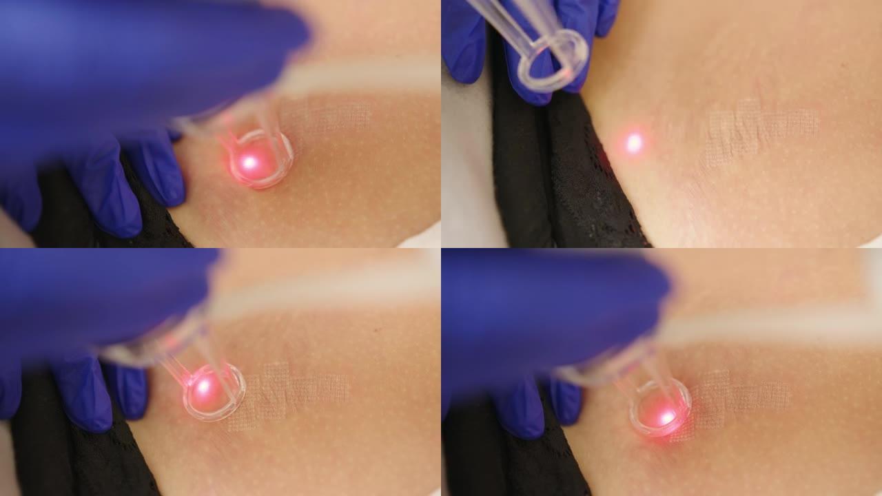 皮肤科的激光整容手术和皮肤重铺。在护肤诊所使用激光，用于皮肤皱纹，疤痕和日光损伤的重铺技术
