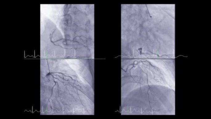 显示冠状动脉的心导管检查以诊断心脏骤停。