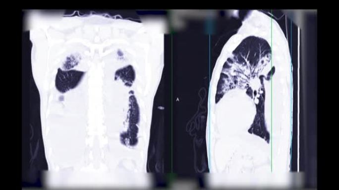 胸部或肺部ct扫描可诊断肺部疾病。