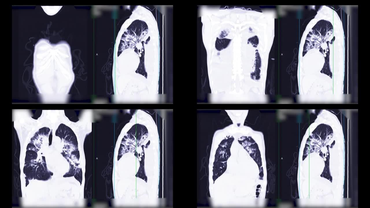 胸部或肺部ct扫描可诊断肺部疾病。