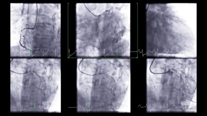 心脏导管插入术是一种用于发现心脏骤停的测试。