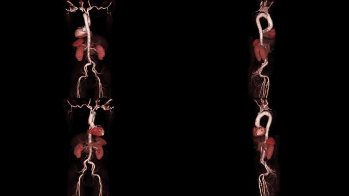 CTA整个主动脉3D渲染在屏幕上翻转以诊断主动脉夹层或动脉瘤。